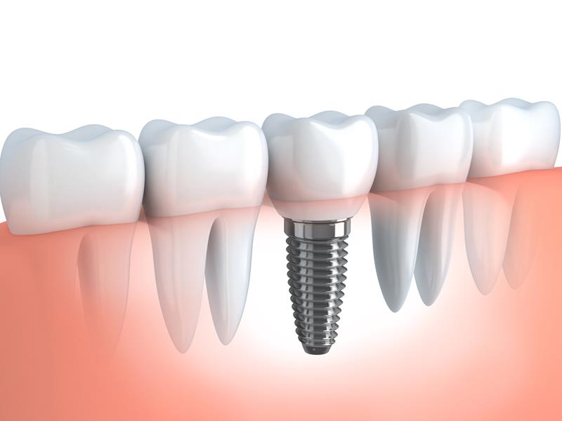 Dental Implants  Washington, DC 